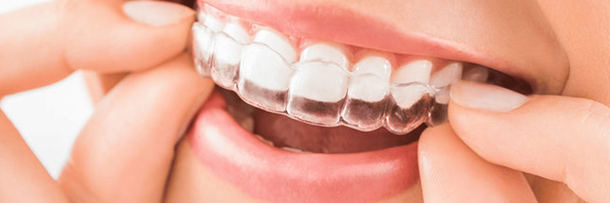 Aligners