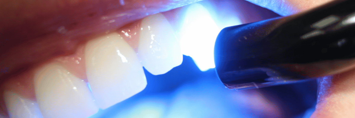 Dental Filling, Polishing