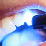 Dental Filling, Polishing