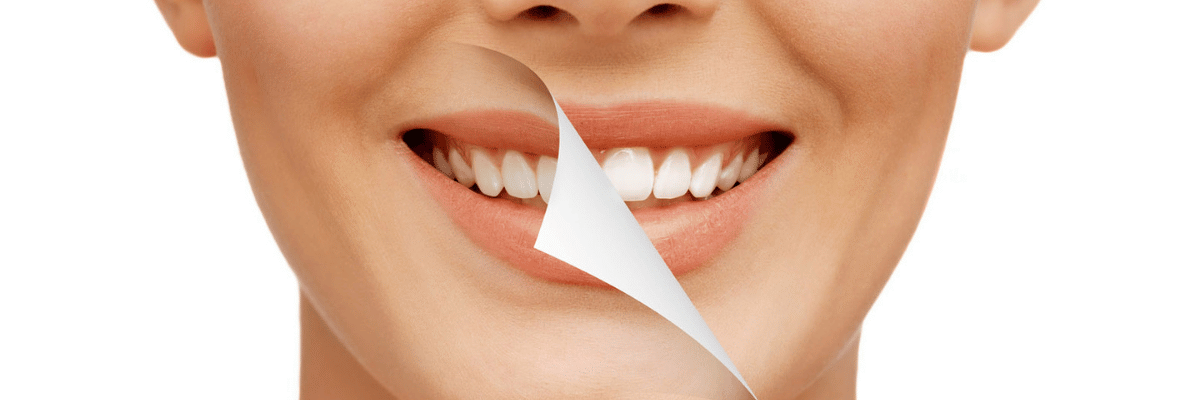 Smile Makeover Smile Makeover